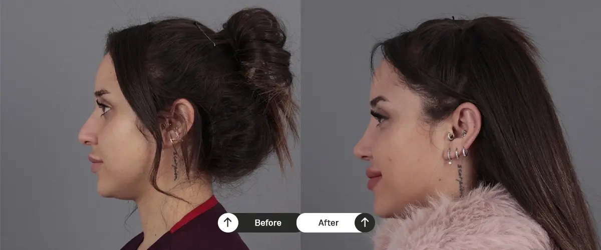Burun estetiği öncesi ve sonrası – 34