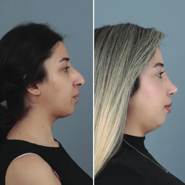 Burun Estetiği (Rinoplasti)